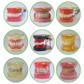 Modèle de pratique d&#39;extraction de dent de dents en métal d&#39;EN-E11 pour la pratique préopératoire de docteur